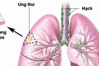 TỐI ƯU HÓA ĐIỀU TRỊ UNG THƯ PHỔI KHÔNG TẾ BÀO NHỎ GIAI ĐOẠN DI CĂN